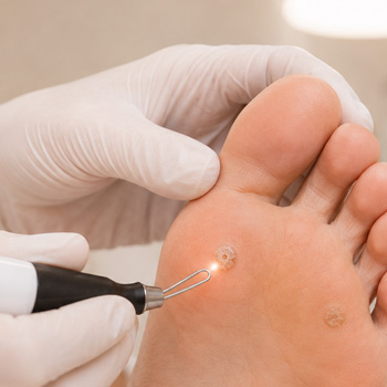 Estetic vårtbehandling, vårtbehandling