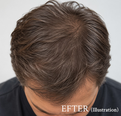 Illustration av man somvisar hårbotten efter Fotona Hair Restart