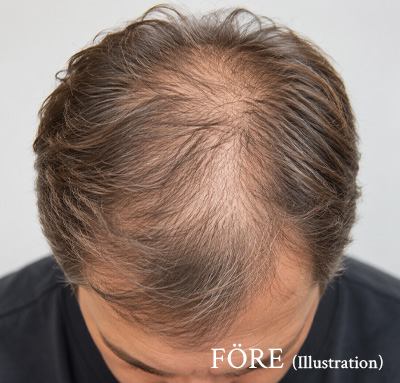 Illustration av man somvisar hårbotten före Fotona Hair Restart
