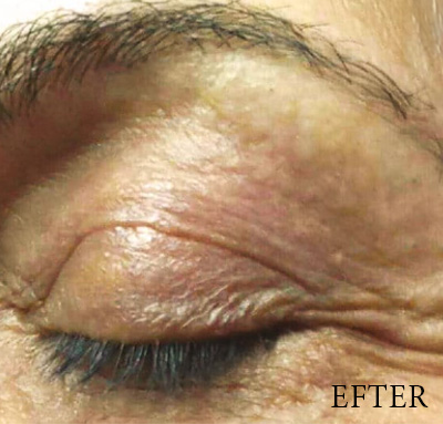 Närbild ögonlock efter behandling med Plexr Plus