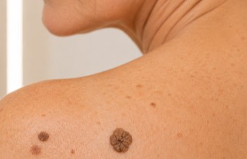 Estetic Seborrhoiska keratoser, Seborrhoiska keratoser behandling