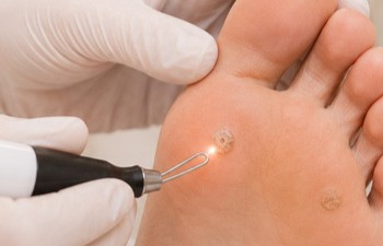 Estetic vårtbehandling, vårtbehandling