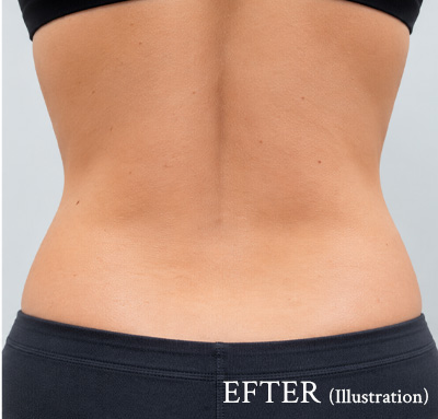 Illustration av kvinnorygg efter TightSculpting