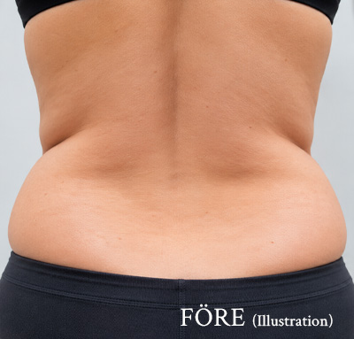 Illustration av kvinnorygg före TightSculpting